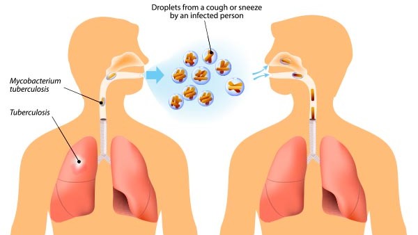 ట్యూబర్క్యూలోసిస్ ట్యూబర్క్యూలోసిస్
