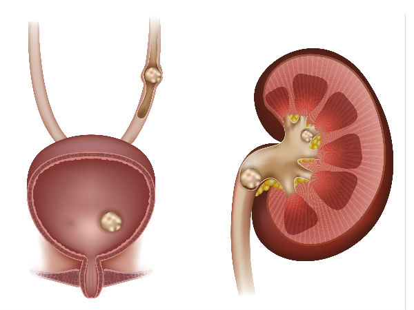 కిడ్నీలో రాళ్ళు.. కరిగిపోవాలంటే ఏం చెయ్యాలి