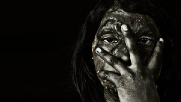 కోడలి ప్రైవేట్ పార్ట్స్ మీద యాసిడ్ పోసిన అత్త