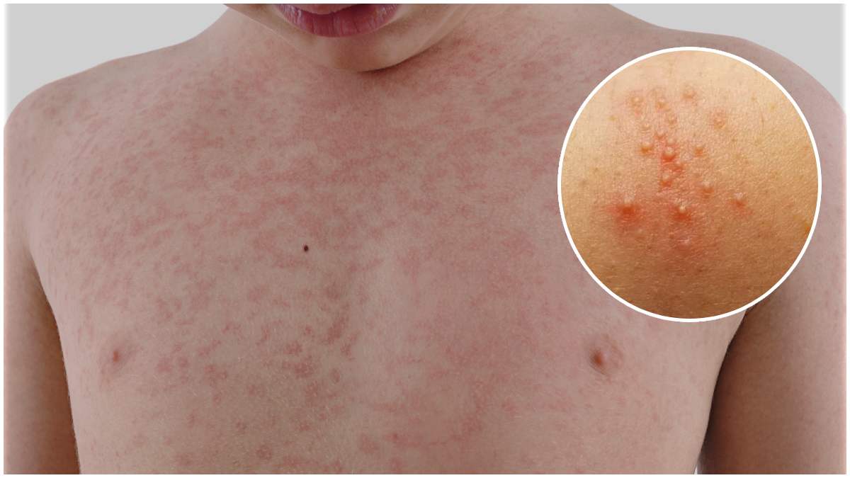 pricklyheat pricklyheat