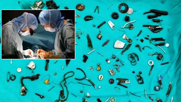 Doctors took out earphones, lockets and rakhis from a mans stomach