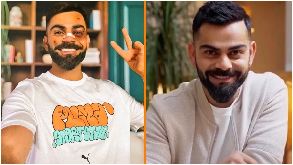  Virat Kohli with facial injuries... post going viral...