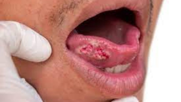  mouth cancer with these symptoms.. be careful!!