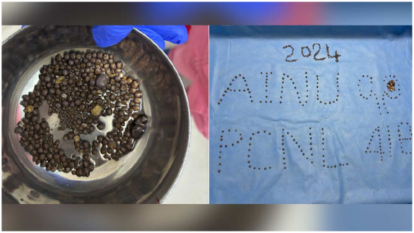 doctors removed 418 kidney stones in a patient at AINU Hospital in Somajiguda Hyderabad doctors removed 418 kidney stones in a patient at AINU Hospital in Somajiguda Hyderabad