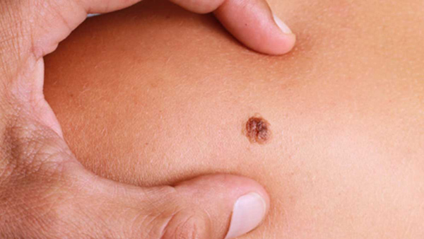 if moles in this part of body are very lucky