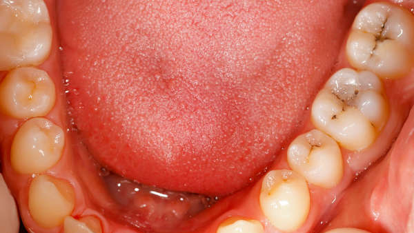 Mouth Cancer chances with Toothpastes carcinogens in toothpastes beware