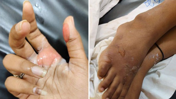 Acid attack on B tech student in ICFAI university in hyderabad