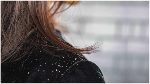 Dandruff and Hair Loss causes