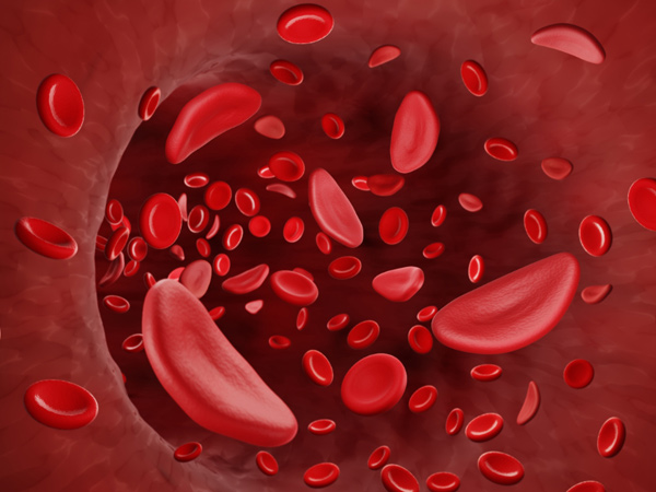 What is sickle cell anemia What are the symptoms What is sickle cell anemia What are the symptoms