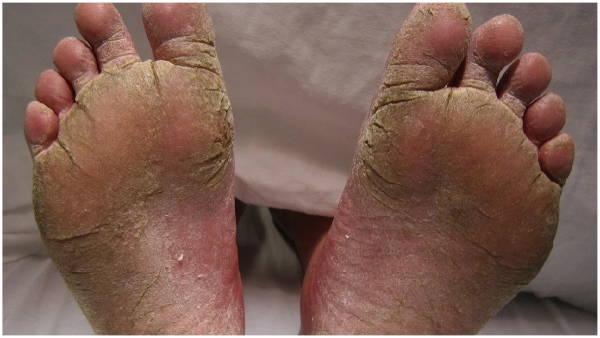 feet cracks reduce health tips details here