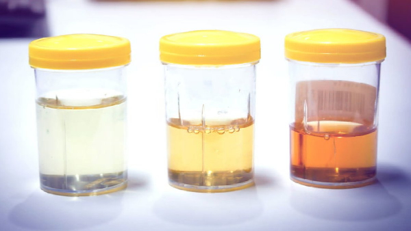 Diseases caused by change in color of urine