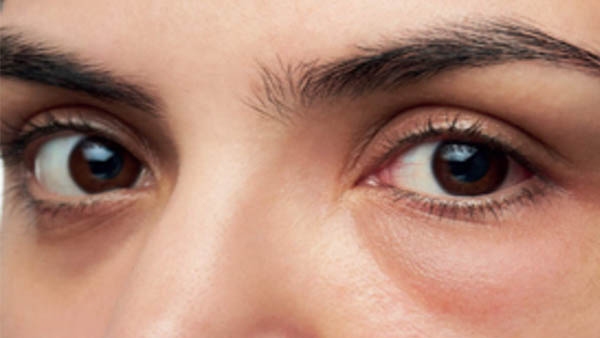 Health tips Remedies to reduce swelling of the eyes do this for eyes puffiness reduction Health tips Remedies to reduce swelling of the eyes do this for eyes puffiness reduction