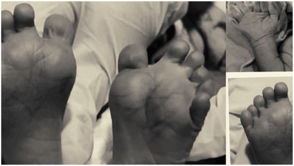 Strange baby born with 25 fingers in Karnataka