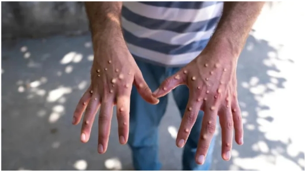 Monkey pox cases rise in the world WHO announced energency here are the symptoms of MPOX