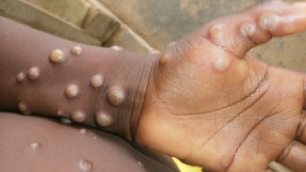 no monkeypox new strain cases in india