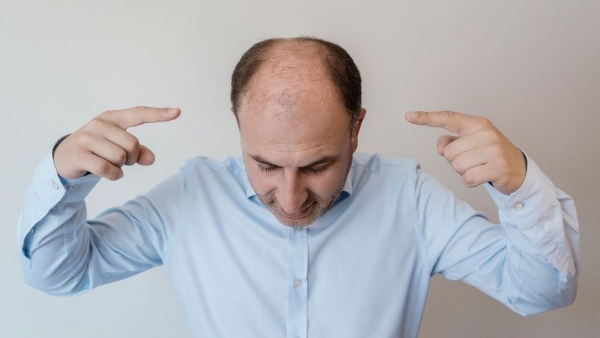 Why baldness is coming only to men
