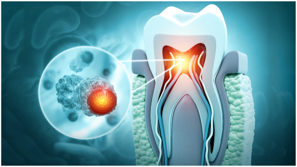 Relation between Root Cana and Heart attacks