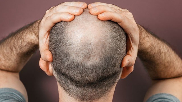 Reasons Your Hair Is Falling Out