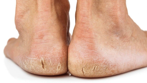 Do this to reduce cracked feet in winter