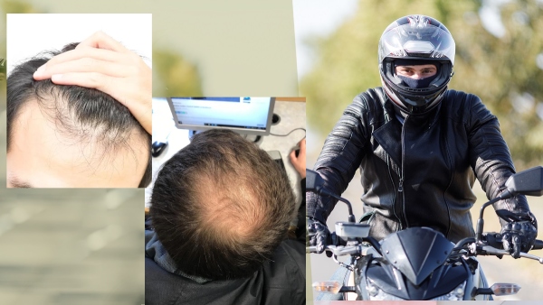 Does wearing a helmet cause hair loss What is true in this