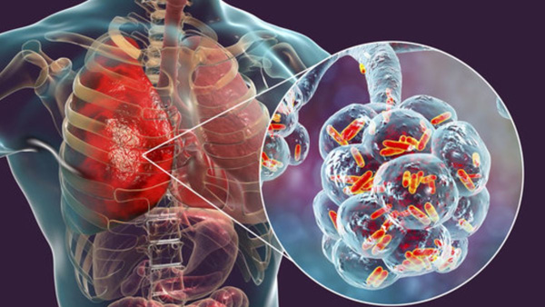 What is walking pneumonia Is it a health hazard