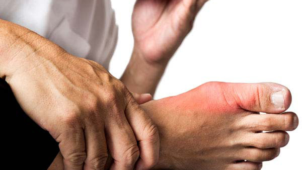 Suffering from high uric acid Then try these homemade drinks