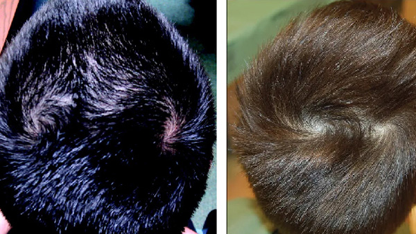 Is it true that having two hair whorls means two marriages