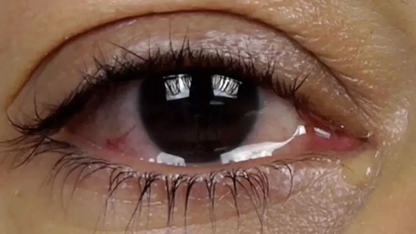 What to do if your eyes are watering