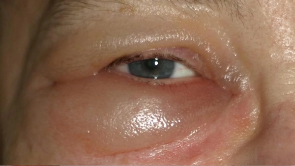 Eye swelling pain linked to arthritis