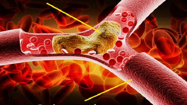 These are the dangerous symptoms that indicate bad cholesterol levels are high Beware