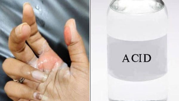 Atrocious on Valentine s Day A young woman was attacked with acid in ap Atrocious on Valentine s Day A young woman was attacked with acid in ap