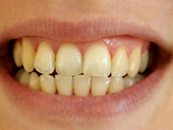 Are your teeth yellow Try these kitchen tips to make them whiter
