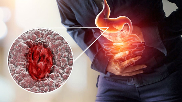 Are you suffering from ulcers First find out what not to eat