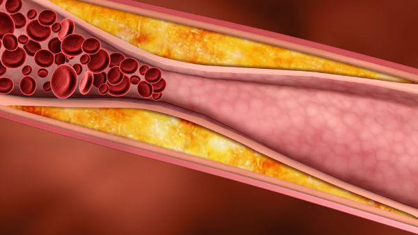 These are the danger signs that appear on the skin if cholesterol increases in the body These are the danger signs that appear on the skin if cholesterol increases in the body