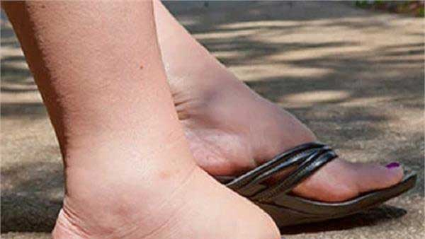 edema with these common and medical health causes don t neglect