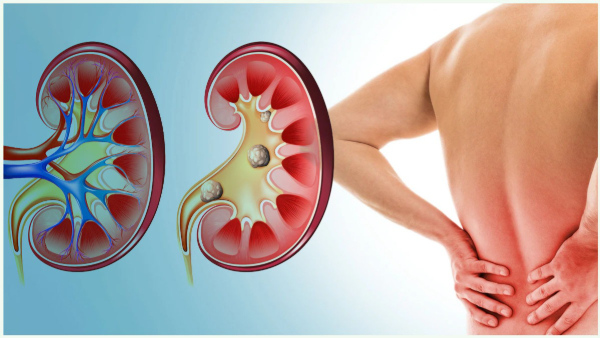 These symptoms indicate that you have kidney stones