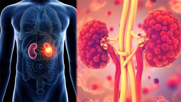 Avoiding certain foods can help improve kidney function