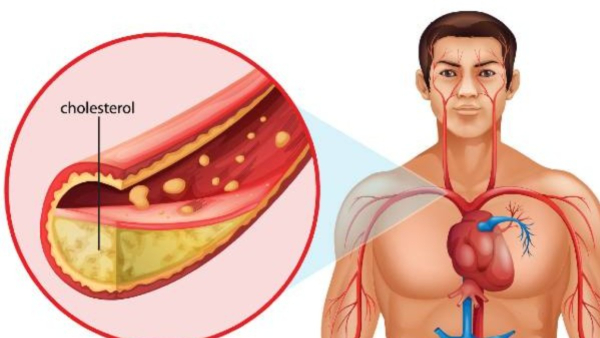 what-is-the-first-noticeable-symptom-of-cholesterol-how-to-reduce what-is-the-first-noticeable-symptom-of-cholesterol-how-to-reduce