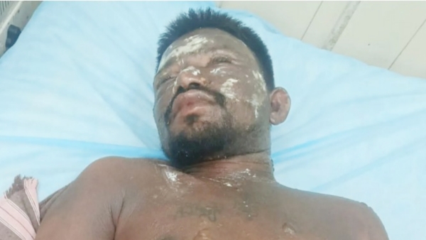 Shocking Bheemili Incident Wife Pours Boiling Water on Sleeping Husband