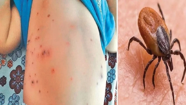 Scrub Typhus Scare Grips Hyderabad Young Children Hit Hardest by Deadly Disease Scrub Typhus Scare Grips Hyderabad Young Children Hit Hardest by Deadly Disease
