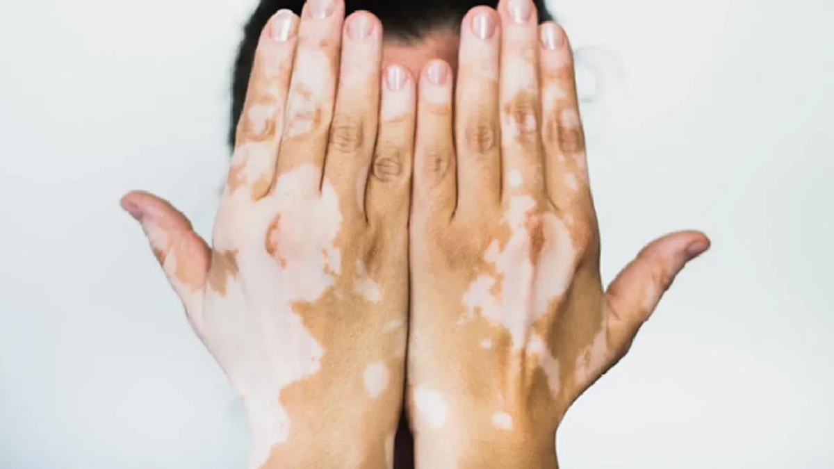 Living with Vitiligo Exploring Solutions and the Hope for a Permanent Cure Living with Vitiligo Exploring Solutions and the Hope for a Permanent Cure