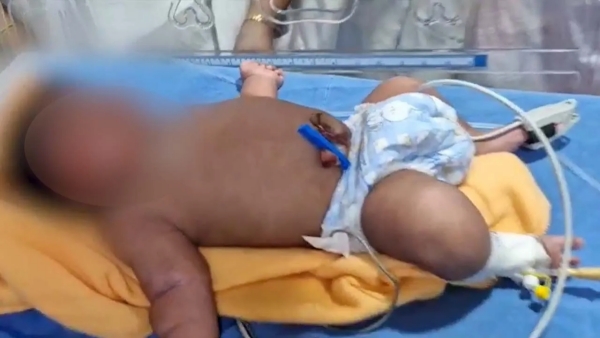 భద్రాచలం ఏరియా హాస్పిటల్ యొక్క పెద్ద ఆశీర్వాదం 5 2 కిలోల జెయింట్ బేబీ సురక్షితంగా రావడం నిజమైన వైద్య అద్భుతం