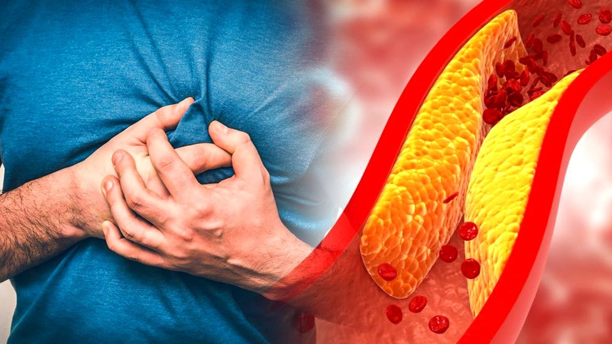 అధిక కొలెస్ట్రాల్​ సైలెంట్ కిల్లర్, లక్షణాలు- ఇలా చేస్తే కంట్రోల్..!!