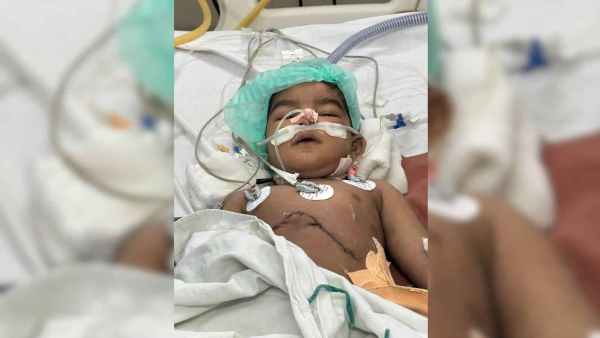 Rare liver transplantation for the first time in india with arogyasri on an 18-month-old boy in osmania Rare liver transplantation for the first time in india with arogyasri on an 18-month-old boy in osmania