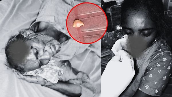 Dowry Harassment Turns Violent in Mancherial Man Bites Off Wife s Nose Police Register Criminal Case Dowry Harassment Turns Violent in Mancherial Man Bites Off Wife s Nose Police Register Criminal Case