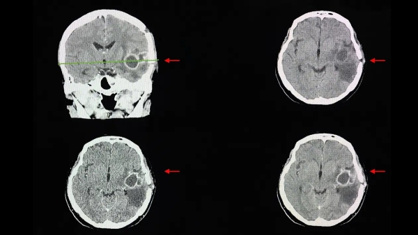 Deadly Fungal Brain Infection Cladophialophora Bantiana Cases Rising What We Know Full Details Deadly Fungal Brain Infection Cladophialophora Bantiana Cases Rising What We Know Full Details