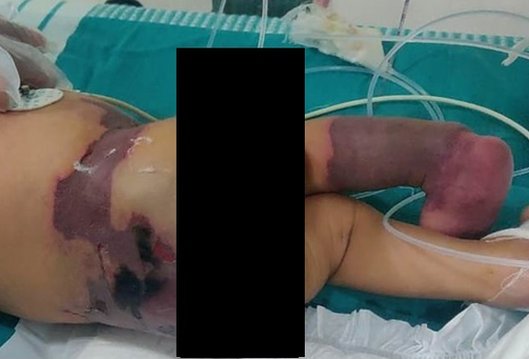 విజయవాడ చిన్నారికి పుట్టిన మూడు రోజుల తర్వాత చర్మం రంగుమారడం, గాయాలు ఏర్పడటం మొదలైంది.