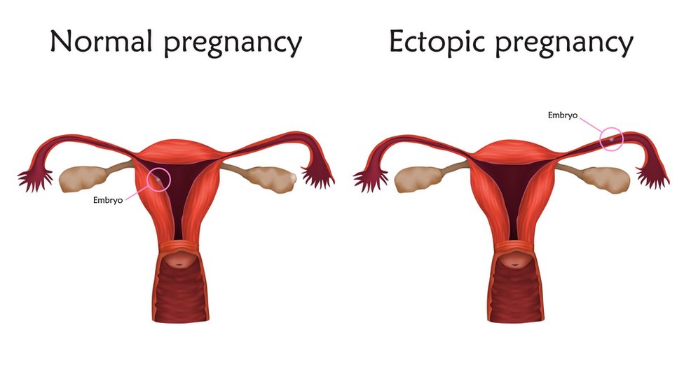 ఎక్టోపిక్ప్రెగ్నన్సీ
