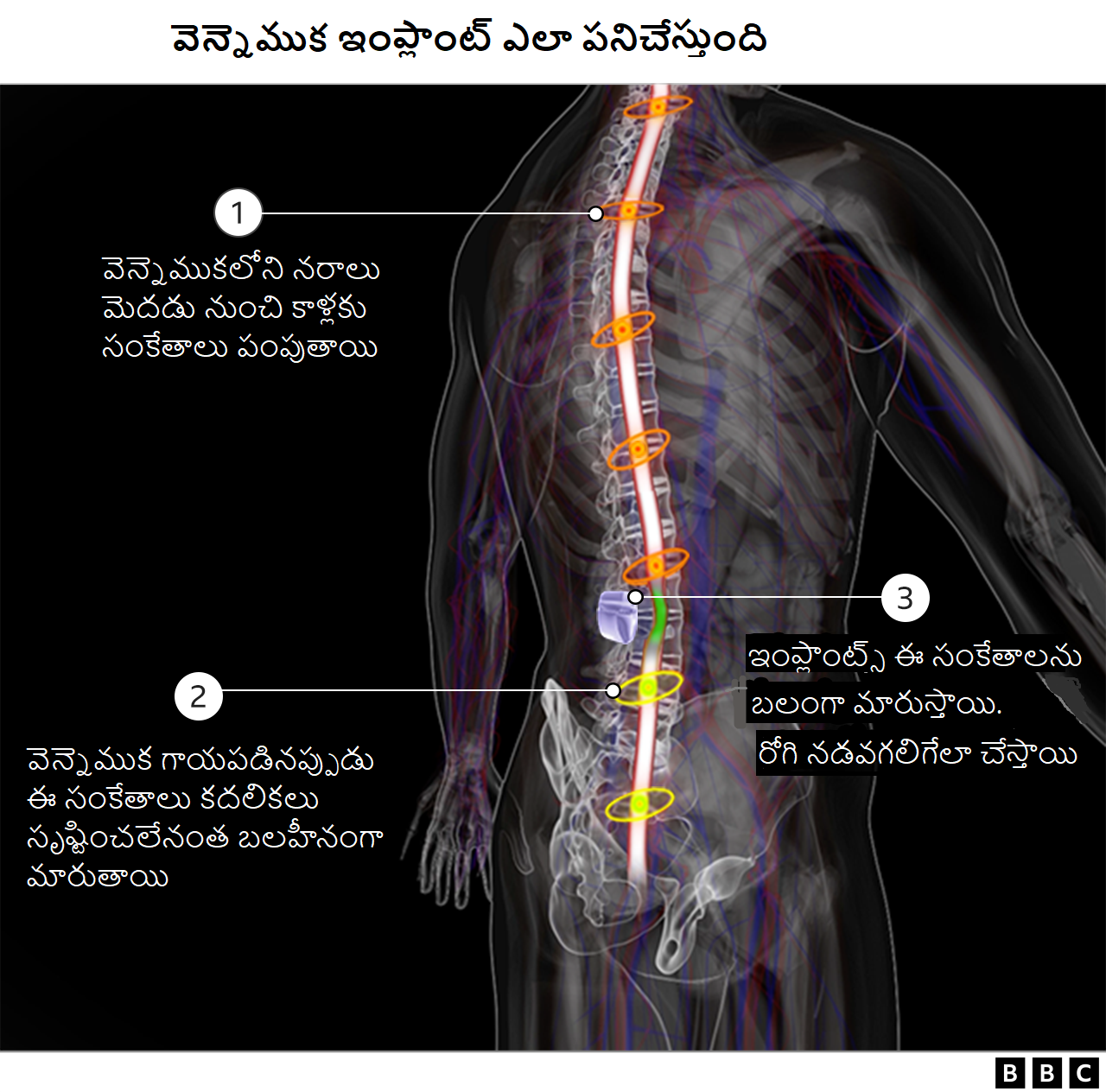 స్పైనల్ ఇంప్లాంట్స్ ఎలా పనిచేస్తాయో చెప్పే చిత్రం