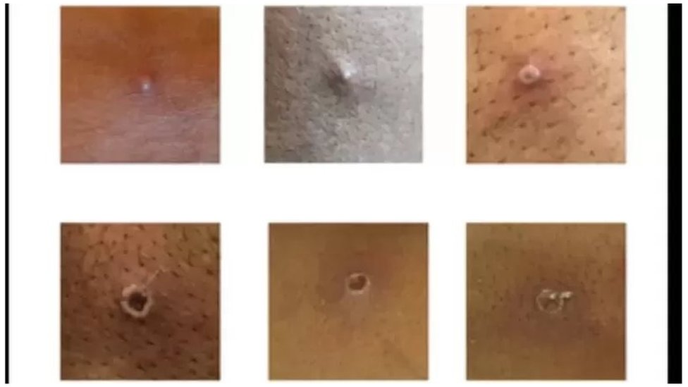 మంకీ పాక్స్